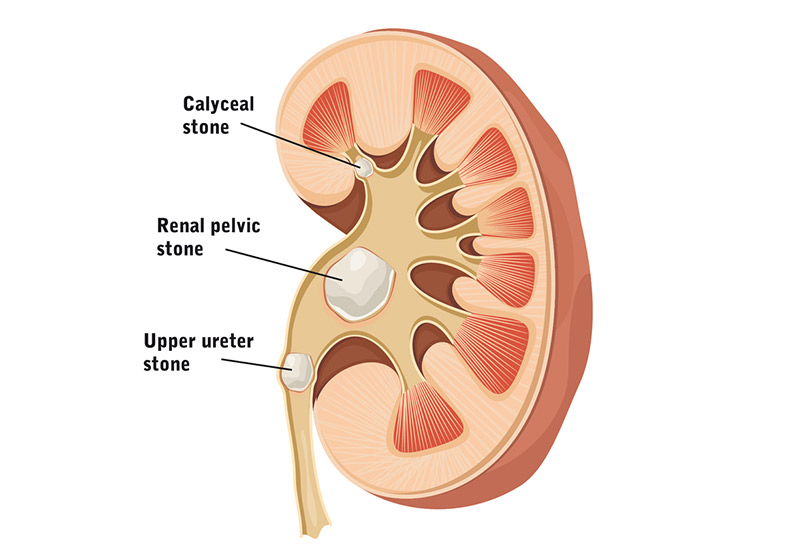 Anatomy of Kidney Stones