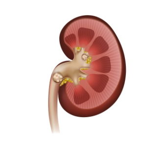 kidneystone icon