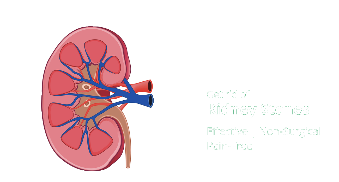 Homeopathic Treatment for Kidney Stones