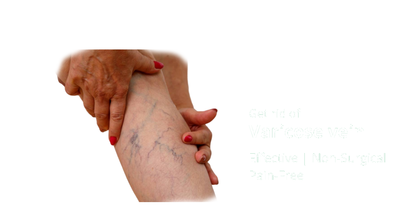 Varicose Veins Treatment in Homeopathy